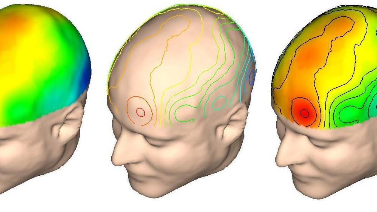 neuroimagen