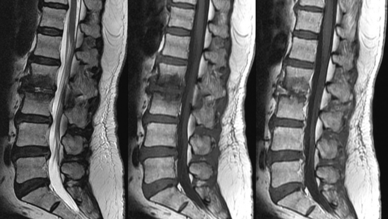 radiografía columna vertebral