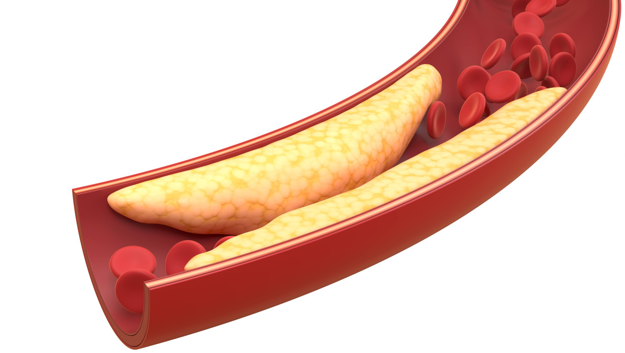 Grasa y glóbulos rojos en vaso sanguíneo
