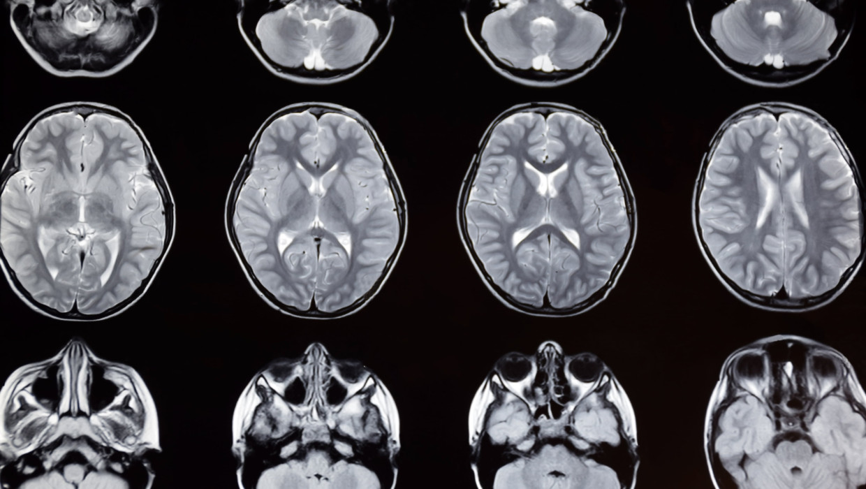 Resonancia magnética del cerebro